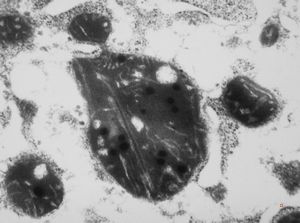 F,14y. | megamitochondria - Wilson disease